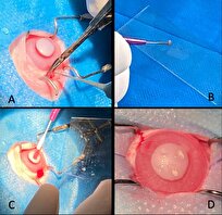 ترمیم زخم قرنیه با روش جدید در دانشگاه تهران