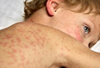 کاهش ۸۸ درصدی مرگ‌ومیر سرخک در جهان؛ اما موارد ابتلا در حال افزایش است