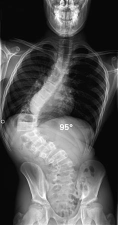 آتاکسی فریدریش آتاکسی فریدریش