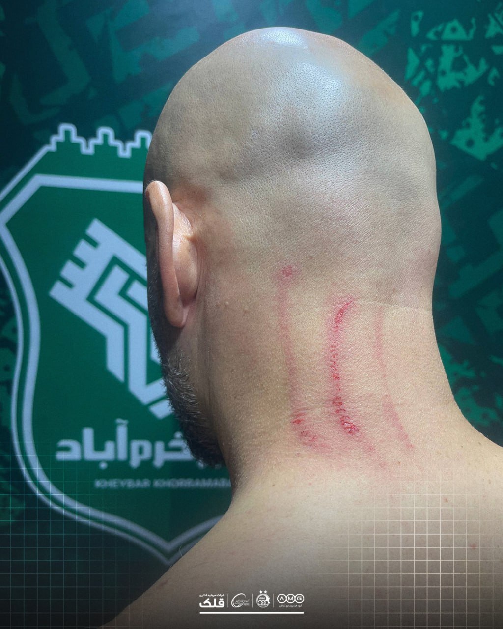 جراحت عجیب مربی دروازهبانهای استقلال پس از دیدار با خیبر+عکس جراحت عجیب مربی دروازهبانهای استقلال پس از دیدار با خیبر+عکس