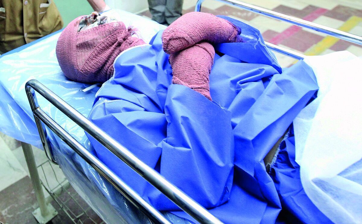 ۳۰۰ هزار مراجعه سوختگی در ایران؛ بیش از ۸۵درصد سوختگی‌ها قابل پیشگیری هستند