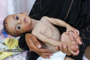 کودکانی که در غزه بر اثر گرسنگی تبدیل به اسکلت شده‌اند