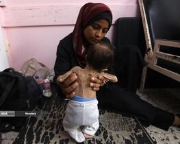 کودکانی که در غزه بر اثر گرسنگی تبدیل به اسکلت شده‌اند