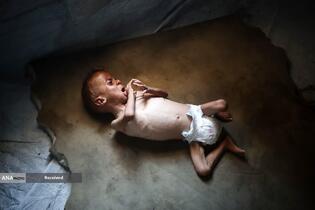 کودکانی که در غزه بر اثر گرسنگی تبدیل به اسکلت شده‌اند