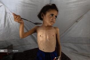 کودکانی که در غزه بر اثر گرسنگی تبدیل به اسکلت شده‌اند