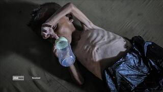 کودکانی که در غزه بر اثر گرسنگی تبدیل به اسکلت شده‌اند