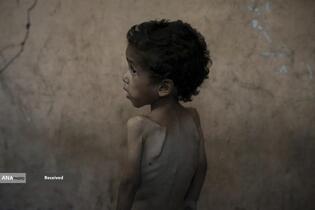 کودکان غزه در صف مرگ بدلیل سوء&zwnj;تغذیه، گرسنگی، و کمبود کمک&zwnj;ها و خدمات حیاتی