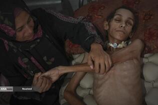 کودکان غزه در صف مرگ بدلیل سوء&zwnj;تغذیه، گرسنگی، و کمبود کمک&zwnj;ها و خدمات حیاتی