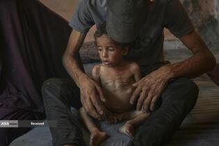 کودکان غزه در صف مرگ بدلیل سوء&zwnj;تغذیه، گرسنگی، و کمبود کمک&zwnj;ها و خدمات حیاتی