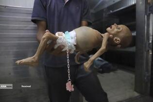 کودکان غزه در صف مرگ بدلیل سوء&zwnj;تغذیه، گرسنگی، و کمبود کمک&zwnj;ها و خدمات حیاتی