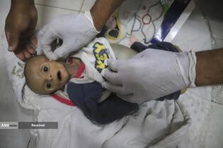 کودکان غزه در صف مرگ بدلیل سوء&zwnj;تغذیه، گرسنگی، و کمبود کمک&zwnj;ها و خدمات حیاتی