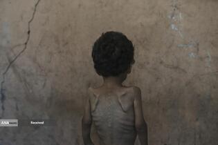 کودکان غزه در صف مرگ بدلیل سوء&zwnj;تغذیه، گرسنگی، و کمبود کمک&zwnj;ها و خدمات حیاتی