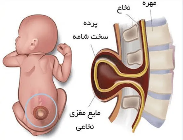 بیماری مننگوسل