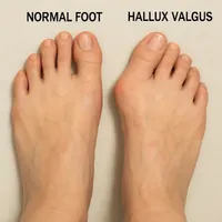 اختراع ایرانی فاتح ژنو ۲۰۲۵؛ دستگاه «هالوکس والگوس» امیدی برای زندگی بدون درد