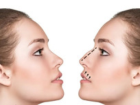 چرا برای جراحی بینی در ایلام، کلینیک آلند انتخاب کنیم؟