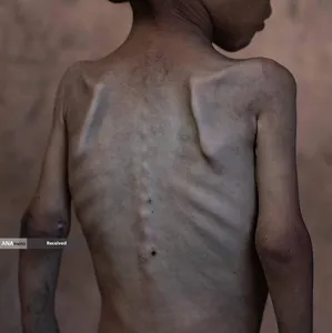 گرسنگی فاجعه بار در غزه