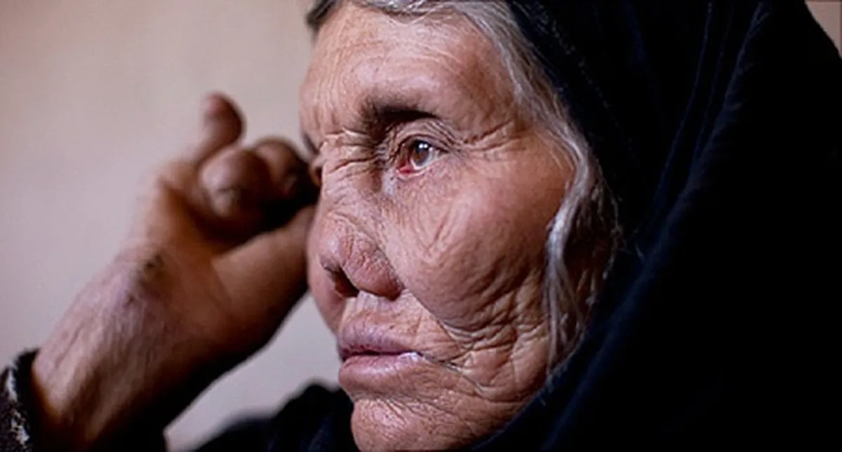 جذام هنوز هم در ایران وجود دارد/ راه‌های انتقال و علائم بیماری
