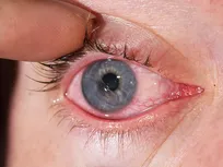 مدیریت اورژانس‌های چشمی در جنگ