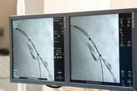 انجام نخستین عمل غیر تهاجمی سنگ شکن عروق قلب در بیمارستان فرهیختگان