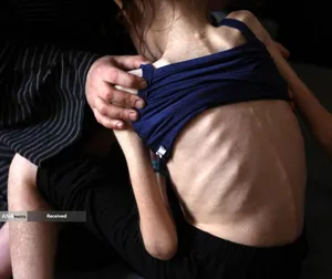 کودکان غزه در صف مرگ بدلیل سوء&zwnj;تغذیه، گرسنگی، و کمبود کمک&zwnj;ها و خدمات حیاتی