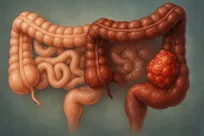 چرا روده بزرگ بیشتر از روده کوچک سرطان می‌گیرد
