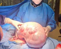 خارج‌ کردن توده ۱۰ کیلویی از شکم یک بیمار در کرج