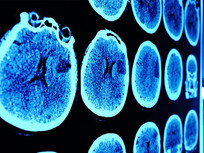Study links head injuries to increased risk of brain cancer mortality
