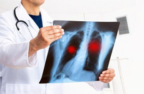 Scientists explore MicroRNA-Based strategy against lung cancer