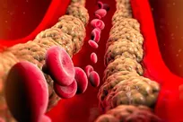 کشف دارویی برای کاهش کلسترول بد و خطر حمله قلبی