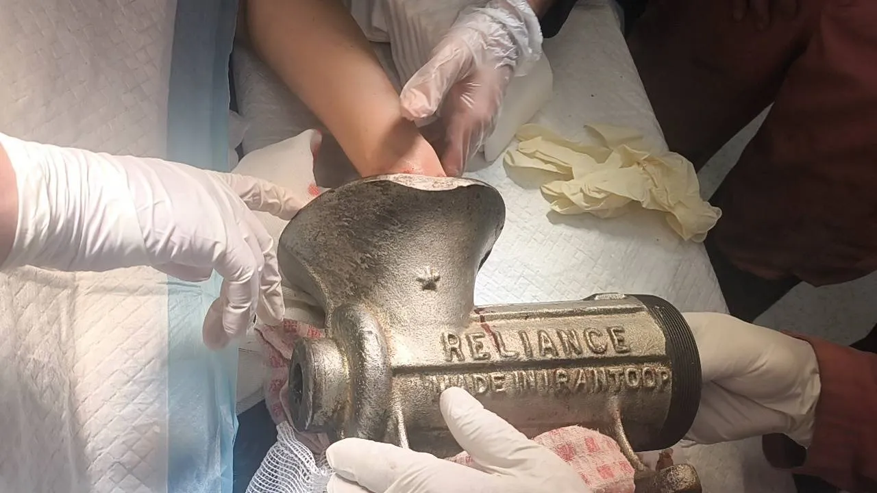 گیر کردن دست در چرخ گوشت