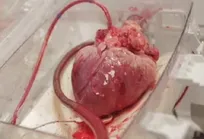 استفاده از یخ خشک به جای یخ طبیعی برای جابجایی قلب، زندگی کودک ایتالیایی را تهدید کرد