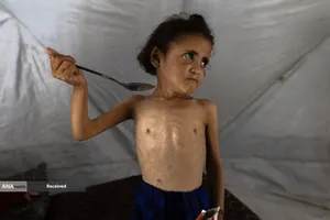 کودکانی که در غزه بر اثر گرسنگی تبدیل به اسکلت شده&zwnj;اند