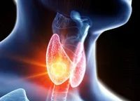 درمان بیماری گواتر با روش کم تهاجمی آمبولیزاسیون شریان