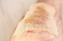 Doctors develop new method to accelerate recovery from gunshot wounds