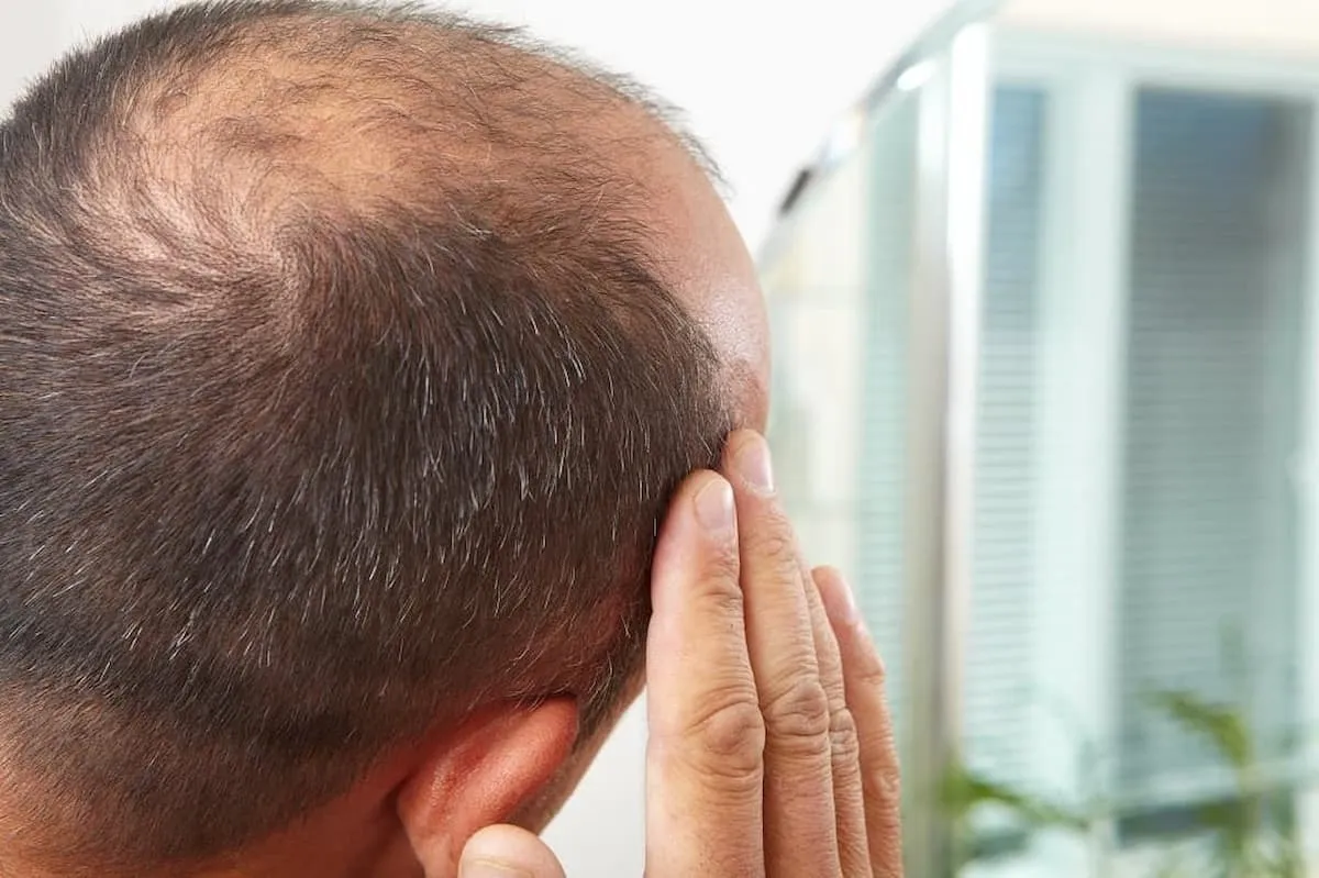 Popular Hair Loss Drug Linked to Suicide