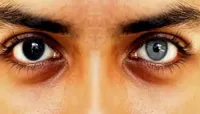 تغییر رنگ چشم؛ دغدغه جدید زیباجویان